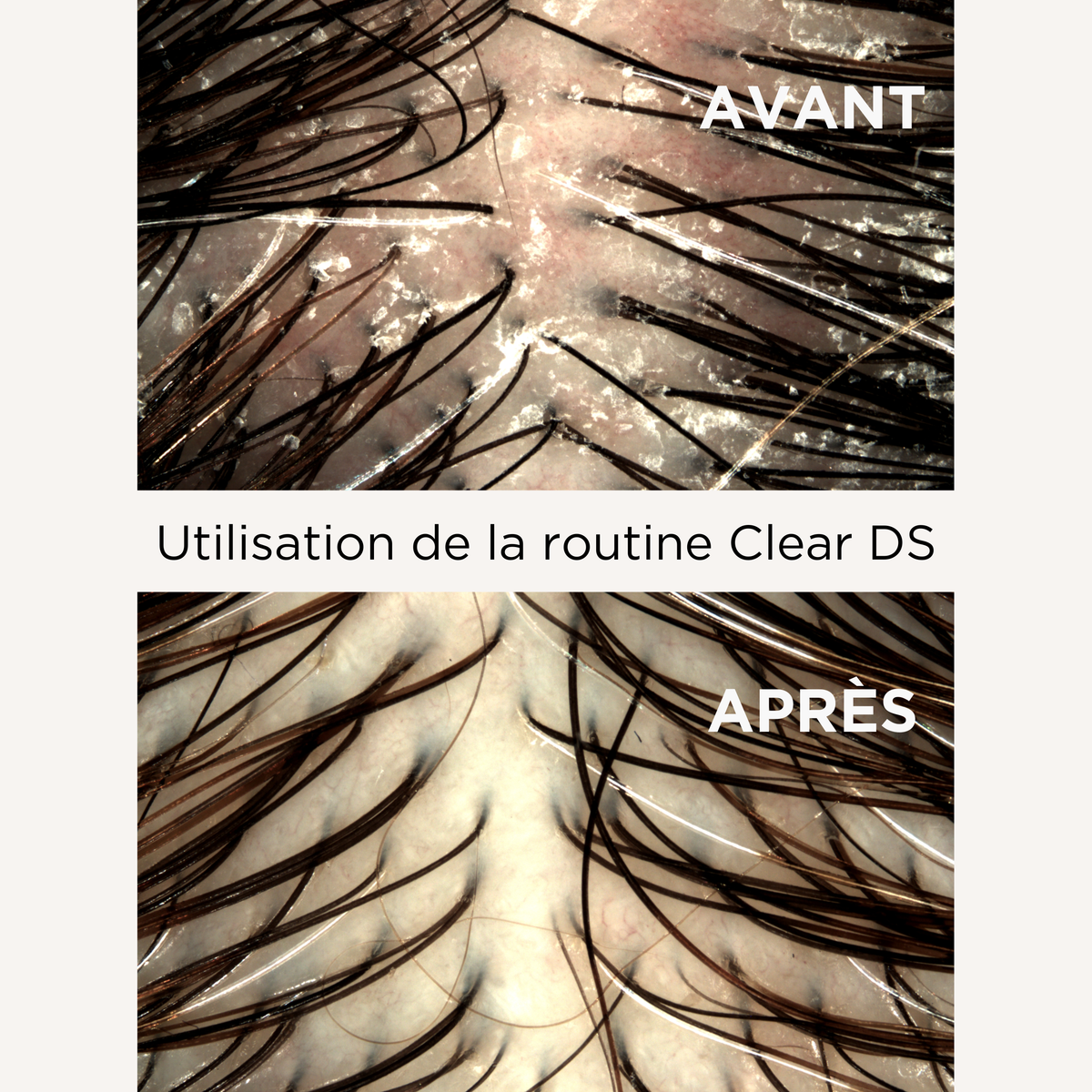 Clear Ds Shampoo (Anti-Dandruff Kerato-Reducing Shampoo)