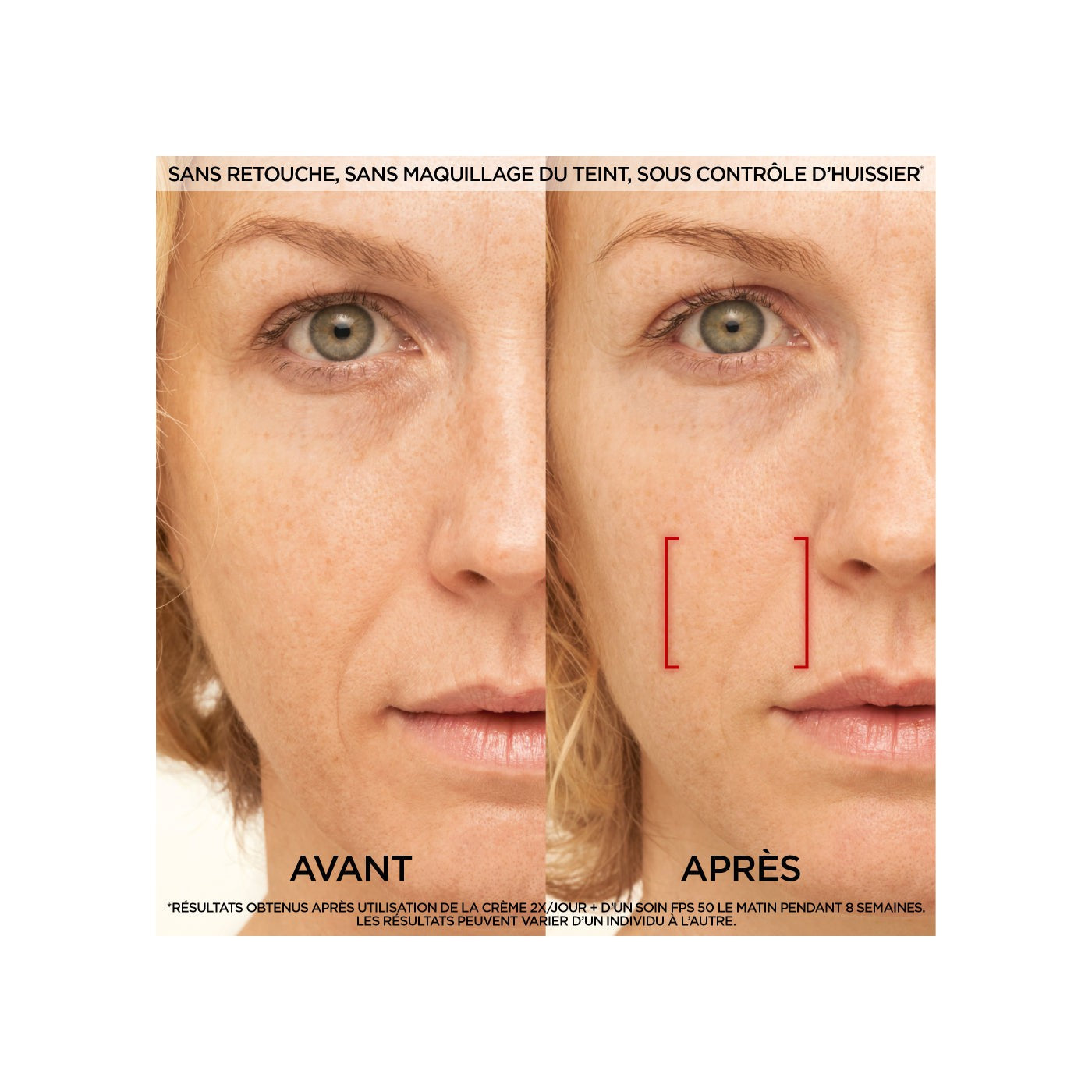 Tratamiento de día antiedad con láser Revitalift