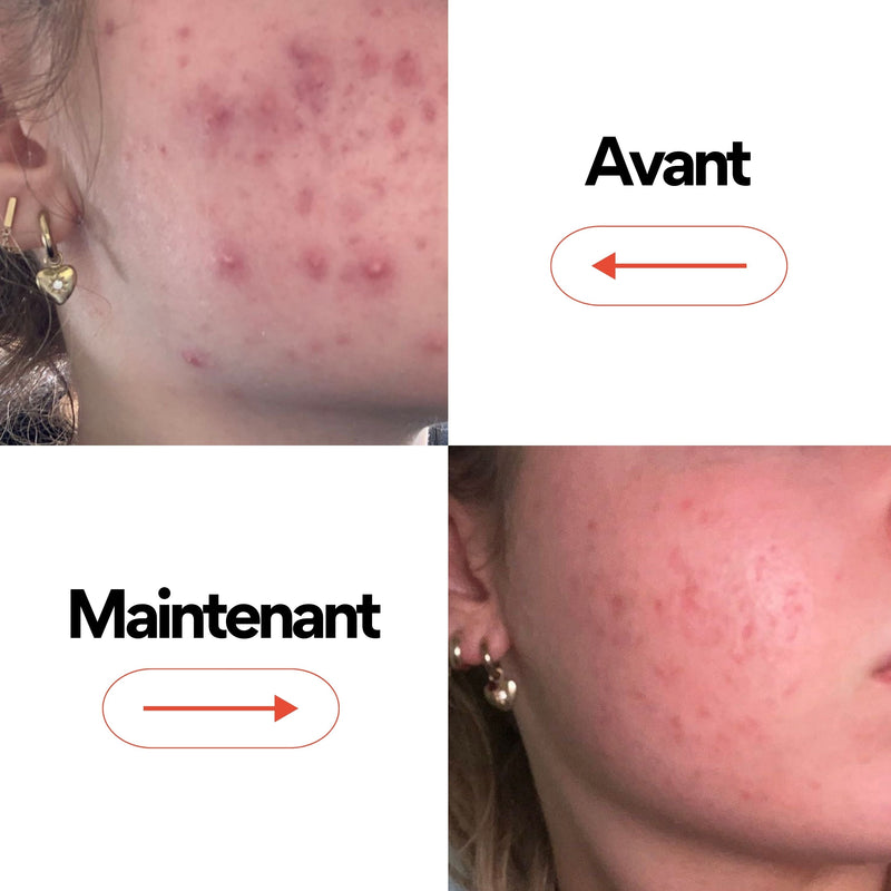 Routine OUT - Routine Skincare Anti-Acné