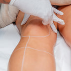 Epilazione Laser Medicale — Mezza Gamba + Inguine Brasiliano + Ascelle — Pacchetto Da 3 Sedute