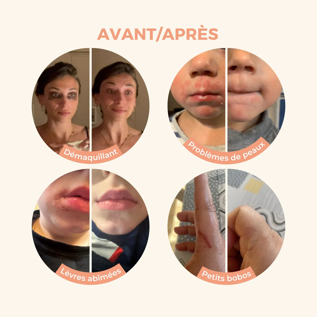 Avant/Après Baume Magique Avis Client Démaquillant Eczéma