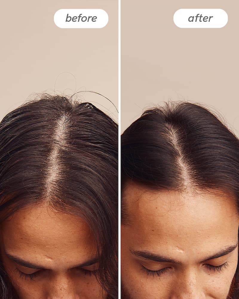 Instant Relief™ Scalp Spray