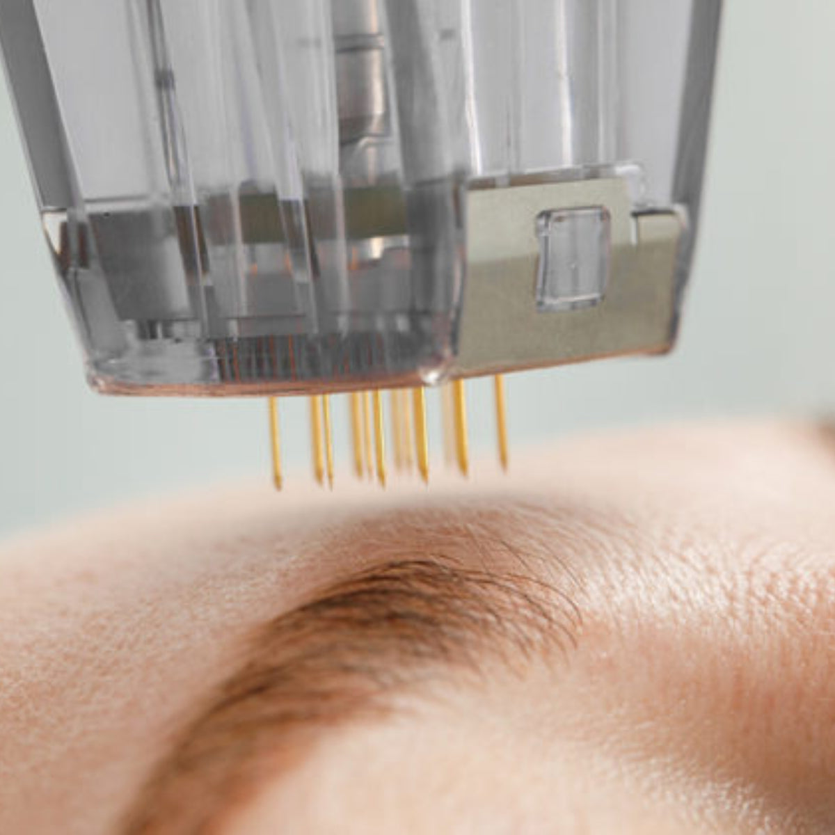 Pack 4 Séances Morpheus8® – Radiofréquence & Microneedling
