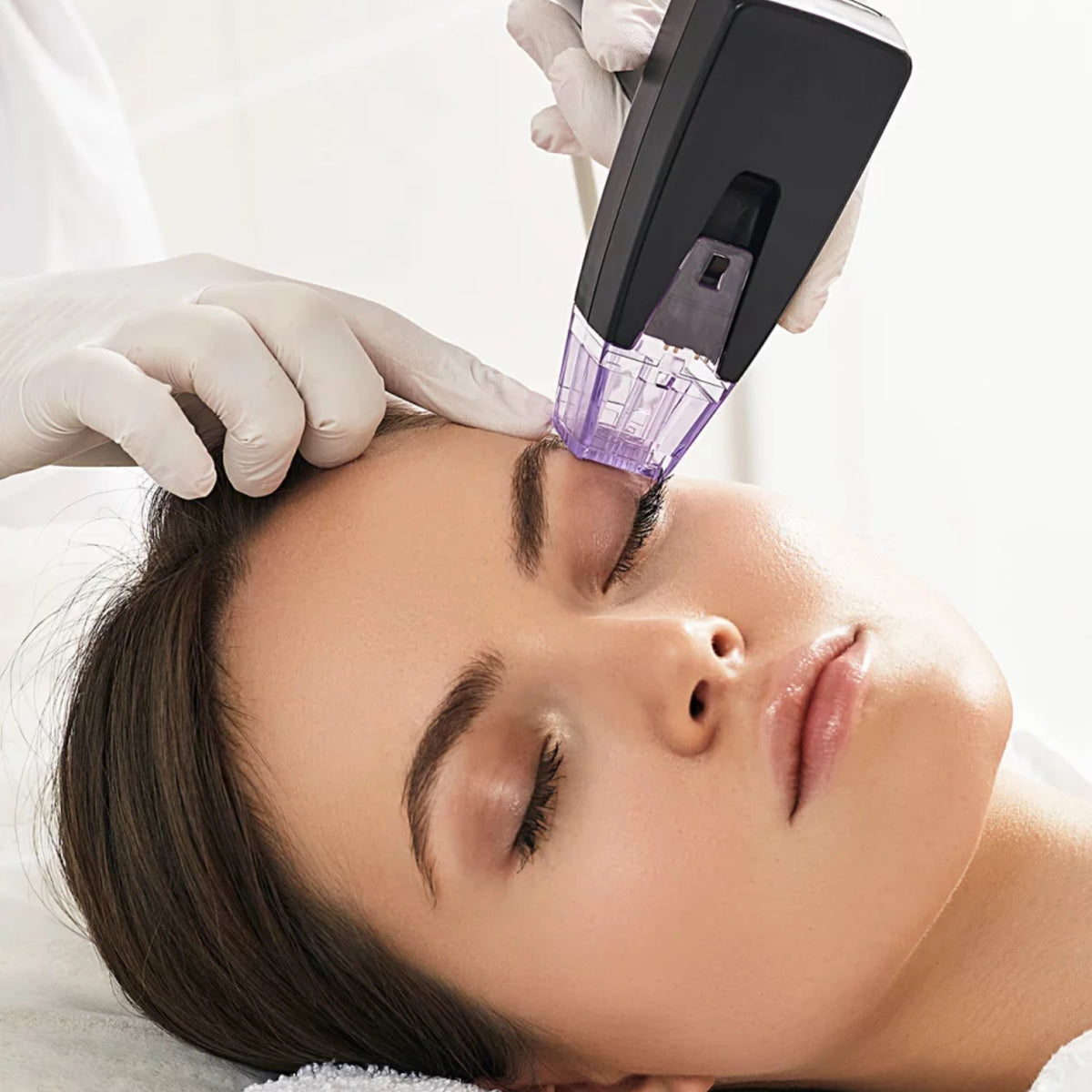 Morpheus8® Visage – 1 Séance Microneedling + Radiofréquence