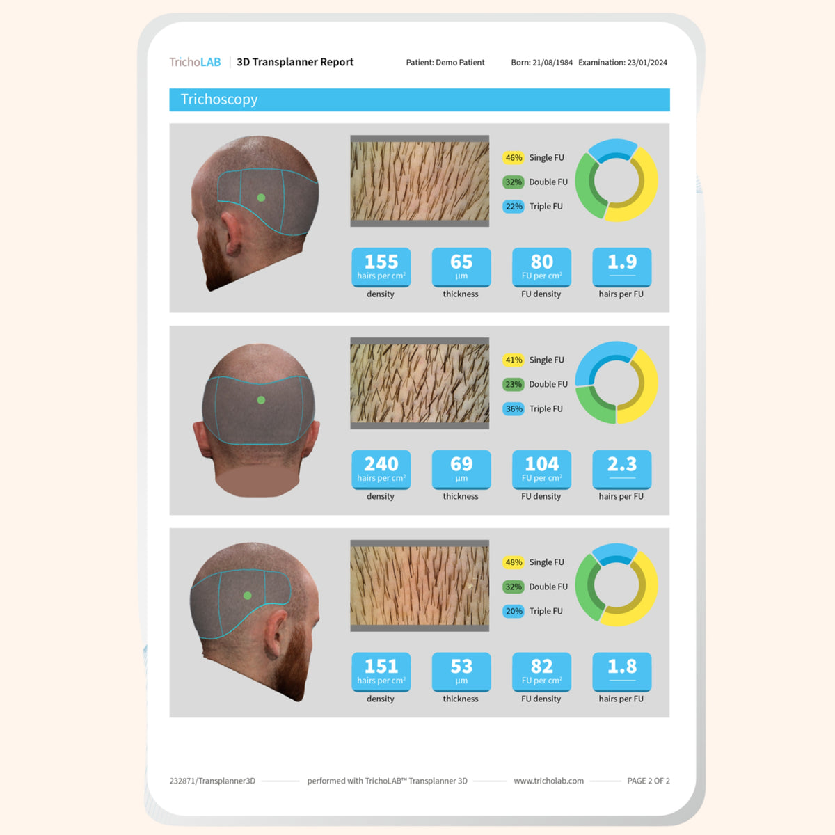 Ciclo Trattamento Anticaduta & Vitalità dei Capelli – Pacchetto 3 Sedute Mesoterapia Capillare + LED in Omaggio