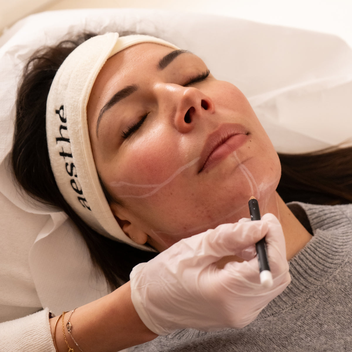 Morpheus8® Visage – 1 Séance Microneedling + Radiofréquence