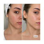 Neodermy LED-Gesichtsmaske – Rot- & Infrarot-Lichttherapie