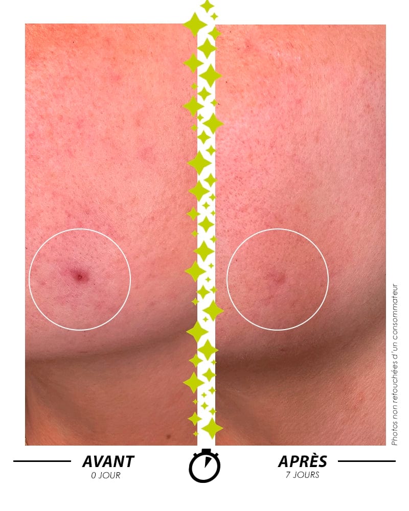 Garancia L'ELIXIR DU MARABOUT Serum: Before/after comparison in 7 days showing the effectiveness of a Garancia treatment on a targeted skin imperfection. The skin is visibly clearer and the skin relief is smoothed.