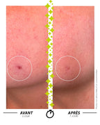 Garancia L'ELIXIR DU MARABOUT Serum: Before/after comparison in 7 days showing the effectiveness of a Garancia treatment on a targeted skin imperfection. The skin is visibly clearer and the skin relief is smoothed.