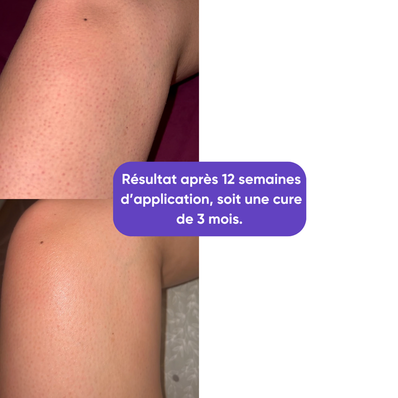 Skin Restore - Crème Kératose Pilaire | Acide Lactique 10%