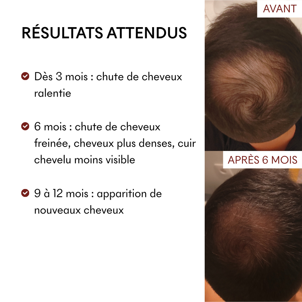 DHT Blocker Hormonal Anti-Hair Loss 3 Months