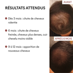 DHT Blocker Hormonal Anti-Hair Loss 3 Months