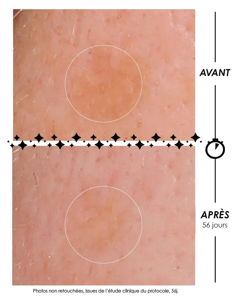 Photographies macroscopiques comparatives avant/après de L'Eclair de lune La Foudroyante : réduction de l'intensité d'une tache pigmentaire sur la peau après 56 jours de protocole clinique Garancia. Photos non retouchées.