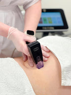Morpheus8® Ciało 2 strefy – Radiofrekwencja mikroigłowa