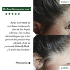 This MakeMyMask anti-psoriasis and dry patches protocol works for me, here is my before-and-after