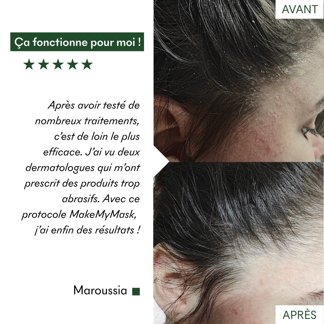 This MakeMyMask anti-psoriasis and dry patches protocol works for me, here is my before-and-after