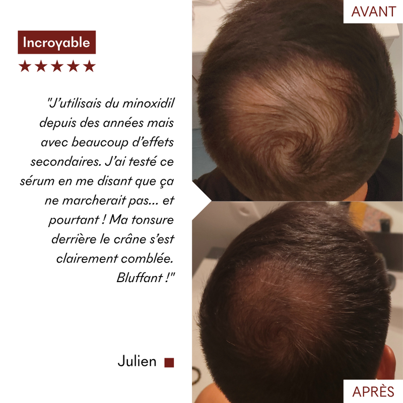 Protocole Anti-Chute Tricho-Boost